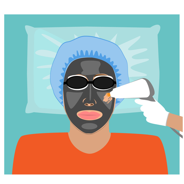 Procedure of carbon peeling, flat vector illustration. Laser rejuvenation and skin lightening, treatment of problematic skin. Carbon laser facial